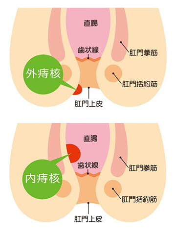 いぼ痔