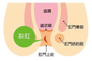 切れ痔