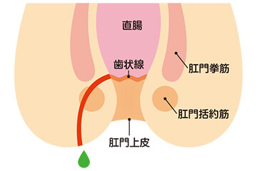 痔ろう