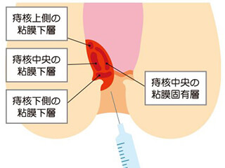 ジオン注射（ALTA療法）