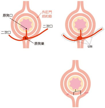 瘻管切開開放術+括約筋温存術(くり抜き法)