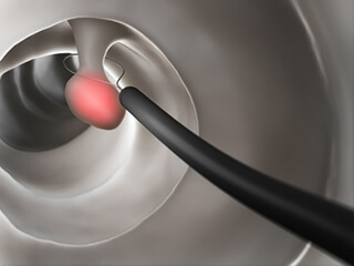 検査中に発見した大腸ポリープはその場で切除